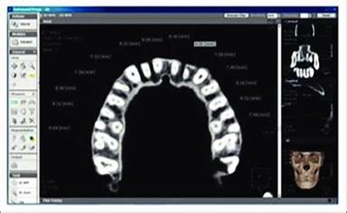 CBCT Image With an Axial View of the Maxillary Jaw after removal of a mini implant.